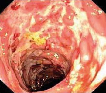 HLAVNÍ TÉMA Farmakoterapie idiopatických střevních zánětů Farmakoterapie idiopatických střevních zánětů Hana Dujsíková Interní gastroenterologická klinika FN Brno a LF Masarykovy univerzity v Brně