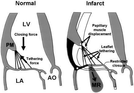 III. Úvod Ischemická mitrální regurgitace Mitrální chlopeň je z anatomického i fyziologického pohledu součástí levé komory srdeční a je tedy zcela logické, že ischemické postižení levé komory (LK)