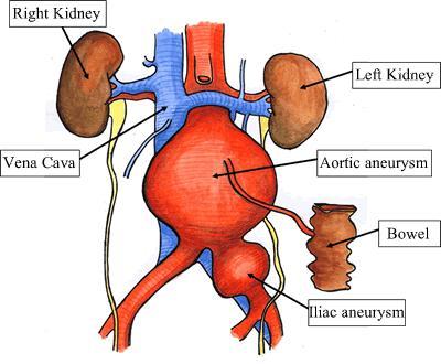 Aneurysma břišní aorty normální aorta 16-22 mm dg.