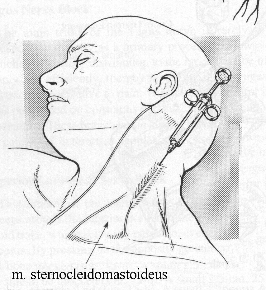 Cervikální blok - intermediální 10 ml 0,75% ropi jehlou 25G do hloubky 15 mm Barone M et al.: Carotid endarterectomy with intermediate cervical plexus block. Tex Heart Inst J.