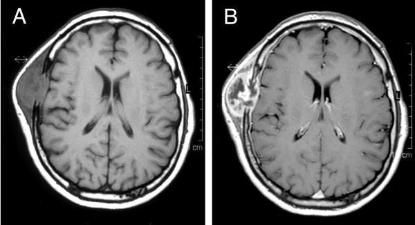 2. KONTRASTNÍ MRI Při kontrastním MRI nesledujeme kontrastní látky jako takové, ale pozorujeme změnu, kterou jejich přítomnost působí na jádra vodíku v jejich okolí.