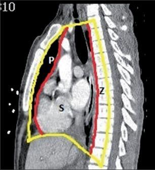 TUMORY MEDIASTINA A JEJICH CHIRURGICKÁ LÉČBA Autor: Martin Likavčan, Kristína Šusterová Školitel: MUDr. Josef Chudáček, Ph.D. Mediastinum je pojem označující hrudní prostor, jenž je po stranách ohraničen pohrudničními dutinami, které obklopují plíce.