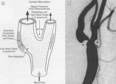 Obr. 4 A Schematická ilustrace lokalizace aterosklerotických plátů v karotické bifurkaci B Angiografie levé karotidy, ilustrující aterosklerotické postižení v místech nízkého smykového napětí (Malek,