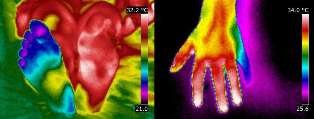 Klinická termografie Termogram vlevo: příklad akutní končetinové ischemie u pacienta s ischemickou chorobou