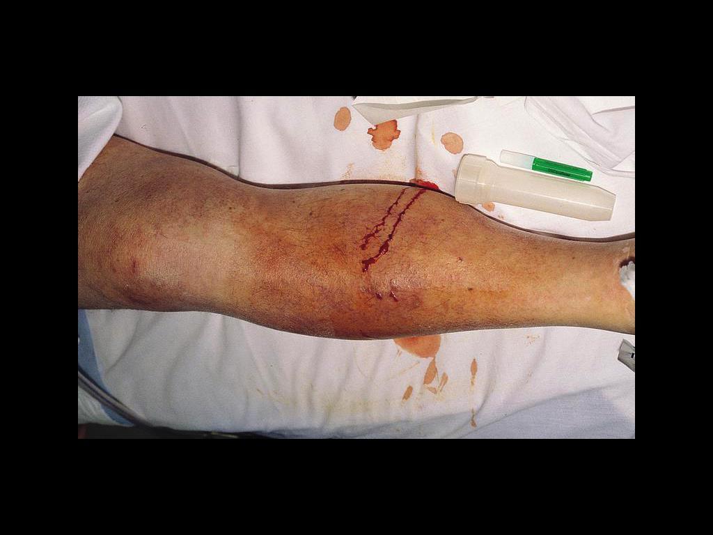 * Necrotizing fasciitis caused by group A strepococci.