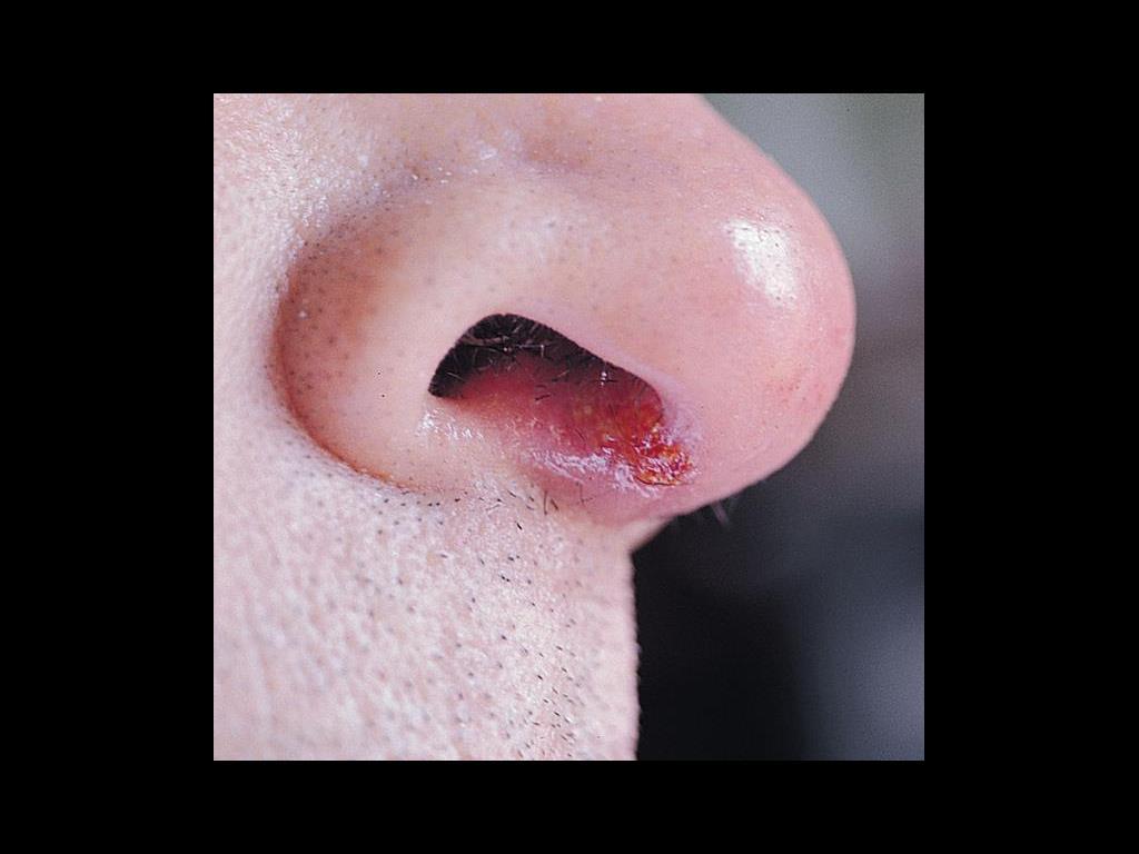 * Staphylococcal nasal carriage.