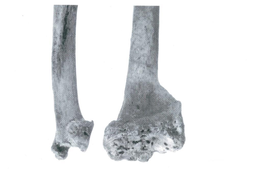 Obrázek 13: Poúrazové a dnové změny kostí markraběte Prokopa v oblasti distálního konce předloktí (upraveno podle: Vlček 2000a, 543