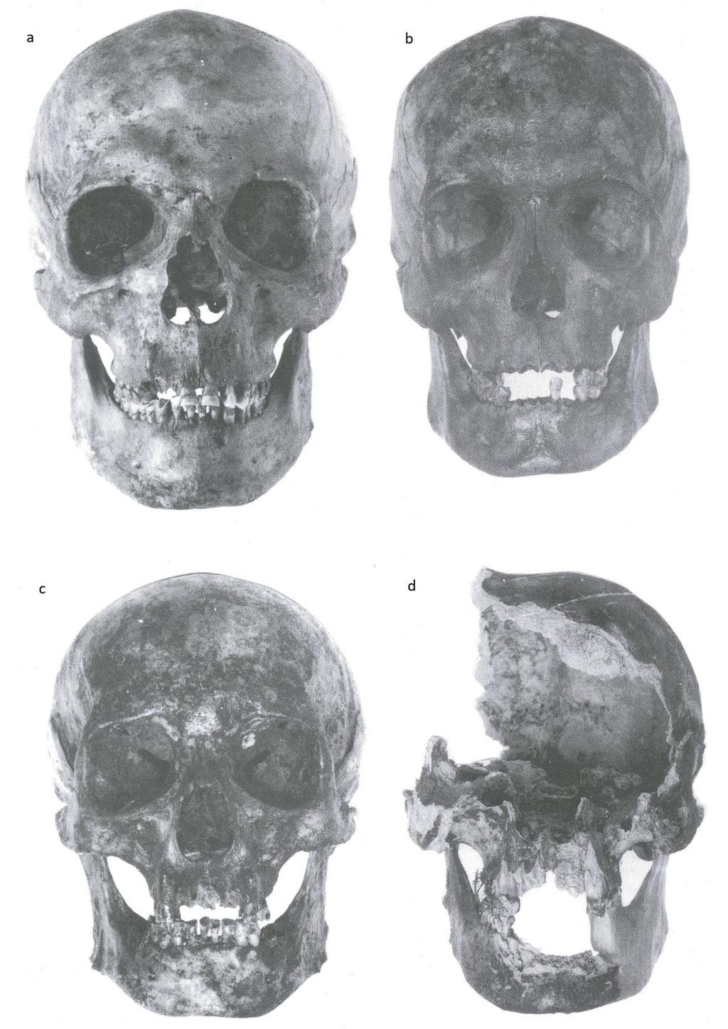 Obrázek 16: Oploštění frontální partie maxily u Lucemburků a) Karel IV; b) Jan