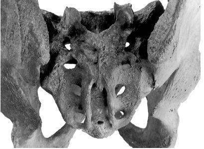 Obrázek 18: Spina bifida křížové kosti u Lucemburků Jan Lucemburský (vlevo nahoře), Karel IV.