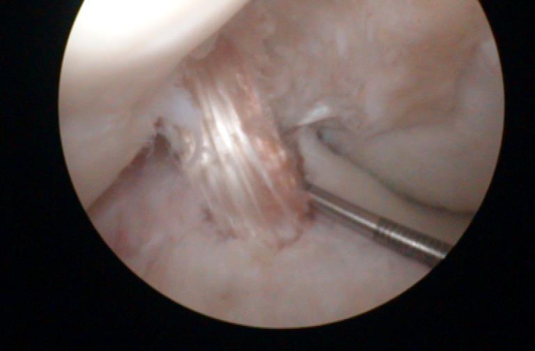 Obr. 10. Upravený štěp ze šlach hamstringů připravený k implantaci (vlevo). Štěp po implantaci v kolenním kloubu (vpravo). Po odběru štěpu operatér připravuje kolenní kloub pro implantaci štěpu.