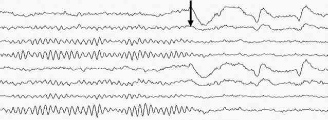 1 Biofeedback v teorii a praxi a možné použít cíleně neurofeedback pro zvýšení pozornosti a potlačení spánku nejen u dětí, ale i u řidičů, pilotů apod. (Faber et al., 2003). 1.