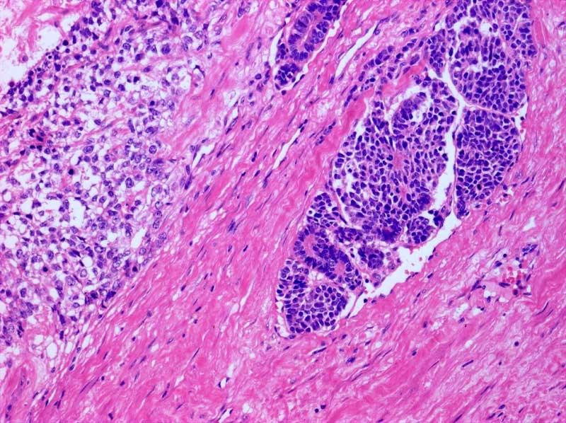 Obr. 8 Embryonální karcinom a karcinoid Přehled 31 Nádor ze žloutkového váčku (Yolk sac tumour) (YST) Synonyma: endodermal sinus tumor, orchioblastom, maligní teratom nediferencovaný (u dospělých).