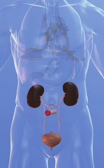 Život s urostomií Pokud máte urostomii, nemůžete již moč vylučovat běžným způsobem. Moč z ledvin odtéká přes močovody do ileálního konduitu, který je vyústěný na břiše jako urostomie.