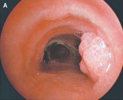 HPV zodpovědné za 4-50% malignit dle