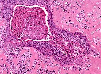 lichen ruben planus [n= 39], lichen ruber erosivus [n = 8], erytroleukoplakia [n =6] 2) benign proliferative lesions papilloma [n =38], verruca