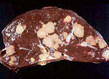 Vředy na játrech Liver ulcers Fusobacterium necrophorum