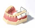INDIKACE: V KOŘENI: překrytí perforací kořene a pulpální dutiny, vnitřní/vnější resorbce zubu, apexifi kace V KORUNCE: hluboké/rozsáhlé kavity, trvalé dentinové výplně, přímé