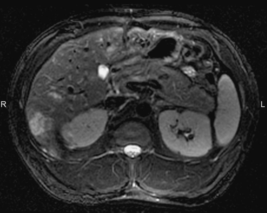 rovině; vícečetná hypointenzní ložiska v játrech 3b