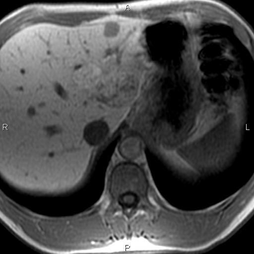 vážený MR obraz v transverzální rovině; hepatospecifická fáze kontrastního vyšetření po podání Gd-EOB-DTPA; převážně hyperintenzní