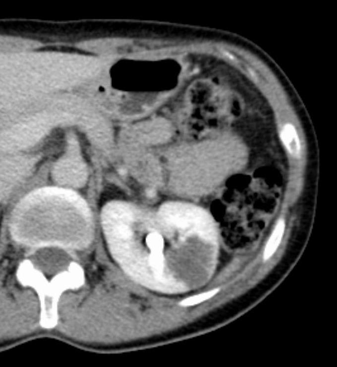 Recidíva a metastázy Tendence k metastazování - velikost, histologie, podíl nekróz < 3 cm - 2,5 % 3-5 cm - 15,4 % > 5 cm - 78 % - po nefrektomii - relaps u 20-30 % medián relapsu do 1,2 let, ( 90% do