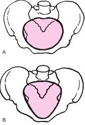Platypeloidní typ má výrazně (transverzálně) oválný vchod. Předozadní a příčný průměr je výrazně menší. U toho typu pánve není vaginální porod vhodný (Leifer, 2004) Obr.