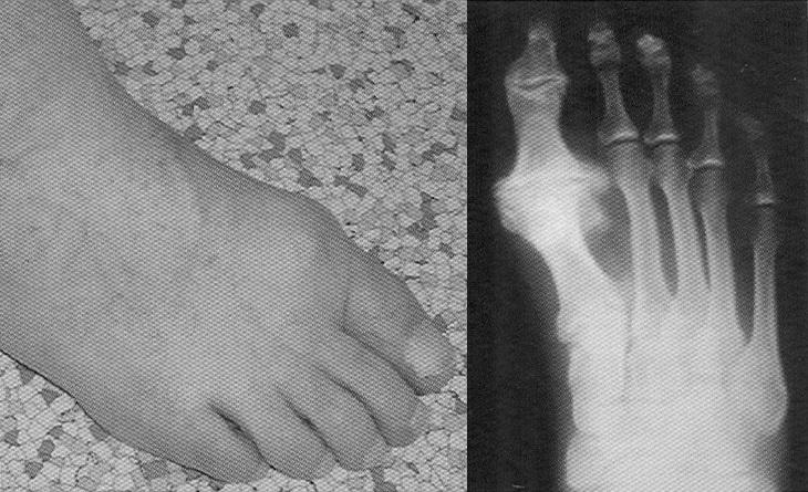 Obrázek 8: Základní operace Hallux valgus. (Kubát, 1975) 5.5 Vybočený palec Opak deformity hallux valgus je tzv. vybočený palec, neboli hallux varus.