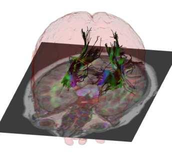 MRI Sledování uspořádání neuronových vláken Healthy control