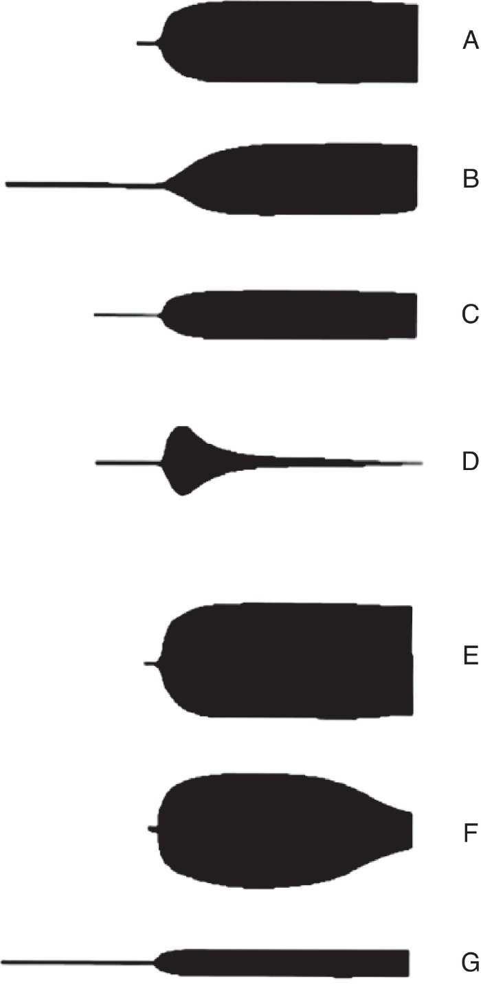 hemodiluci nebo po warfarinu či heparinu. Úzký úhel alfa a MA jsou známkou výrazného poklesu a/nebo dysfunkce destiček, ale také hypofibrinogenemie.