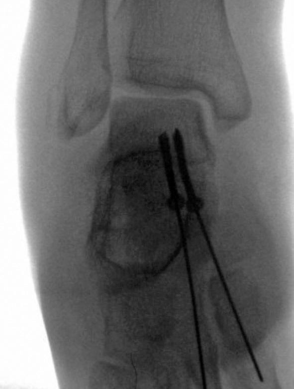 122/ Acta Chir Orthop Traumatol Cech.
