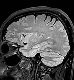 : A comparative MRI study for white matter hyperintensities