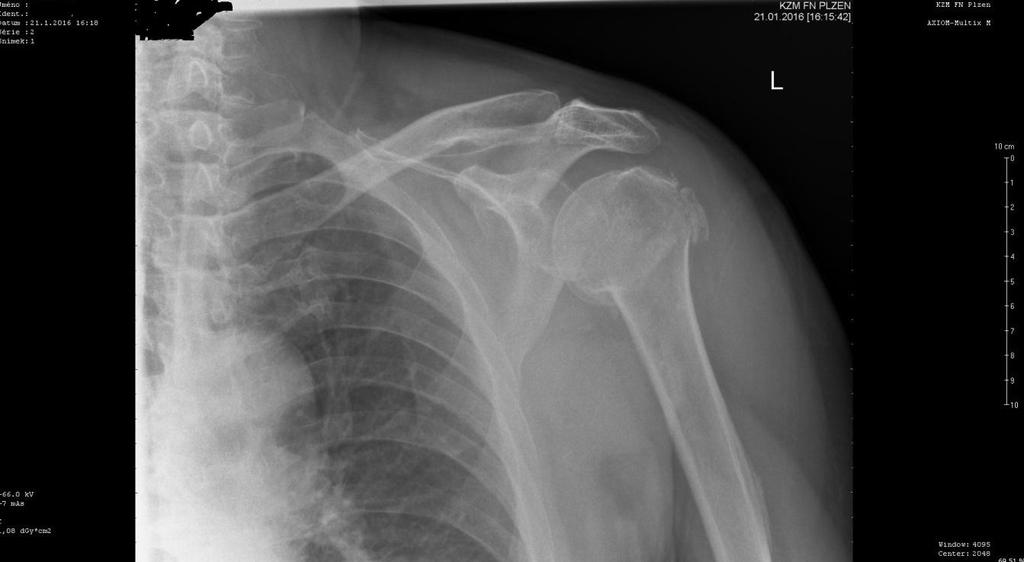 5 KAZUISTIKY 5.1 Kazuistika č. 1 Muž, 71 let Anamnéza: Pacient navštívil úrazovou ambulanci FN Plzeň 21. 1. 2016 po údajném pádu. Stěžoval si na bolest levé končetiny.
