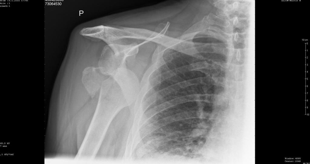 5.4 Kazuistika č. 4 Muž, 71 let Anamnéza: Pacient navštívil 8. 1. 2016 úrazovou ambulanci po pádu ve své domácnosti. Poranil si pravé rameno. Je alergický na kyselinu acetylsalicylovou.