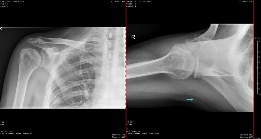 Obrázek 17: Kontrolní RTG vyšetření, AP a