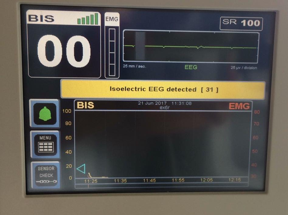 ! Ne paušální premedikace BZD a anticholinergiky Minimalizace lačnění Typ anestezie a použitá