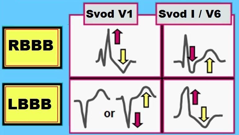 Vyskytuje se u: ICHS IM Aortální stenóza[10] RBBB Blokáda pravého raménka Tawarova Stejně jako LBBB se rozlišuje inkompletní a kompletní blok, kdy je kompletní je QRS rozšířen nad 0,12 s a