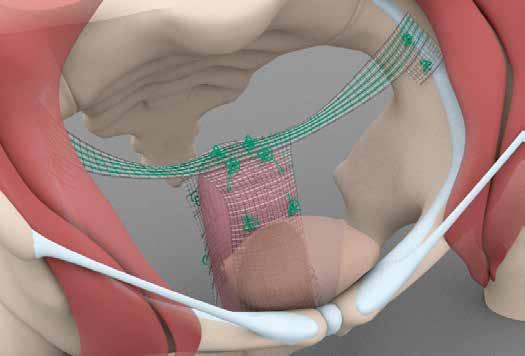 Pektopexe Apikální síťová plas s bilaterální fixací k ligamentum iliopectineum Promontorium Psoas major