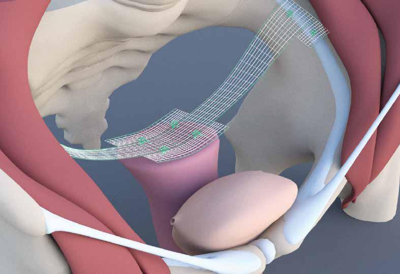 prostoru laterální fixací k ligamentum iliopectineum.