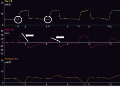 autotriggering Klinický obraz Mechanický dech bez inspiračního úsilí Nepoměr mezi dechovou frekvencí ventilátoru a pacienta Křivky na ventilátoru Není pokles tlaku před mechanickým