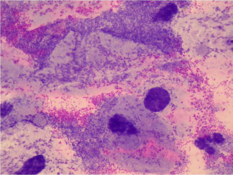MOP II Bakteriální vaginóza epitelie