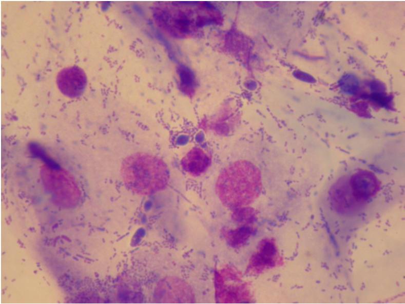 MOP VI Vaginální mykóza epitelie leukocyty (s
