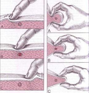 3.5.3 Palpace Dle Lewita (2003) je palpace jedno z nejdůležitějších a nejjednodušších vyšetření v diagnostice TrPs.