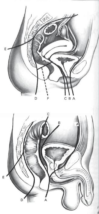 Typy pelvických exenterací Pelvické exenterace dělíme na čtyři základní typy: přední, zadní, supralevátorové a totální Obrázek 2 Pelvické exenterace: přední A-C, zadní B-D, totální A-D, totální