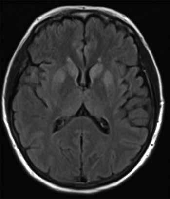 294 Obr. 1, 2. Ilustrativní MRI vyšetření mozku pacientů se scjn Obr. 1. FLAIR sekvence hyperintenzní změny bazálních ganglií, thalamu, kortexu Obr. 2. DWI sekvence hyperintenzní změny bazálních ganglií (především nucleus caudatus) oboustranně jen jedno, orientace místem a časem zachována.