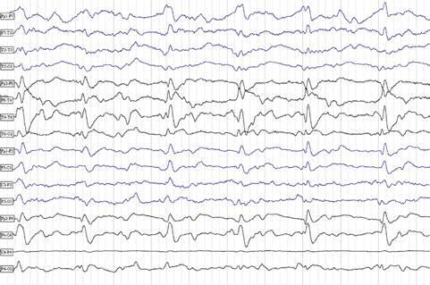 295 Obr. 3. EEG nález pacientky Obr. 4.