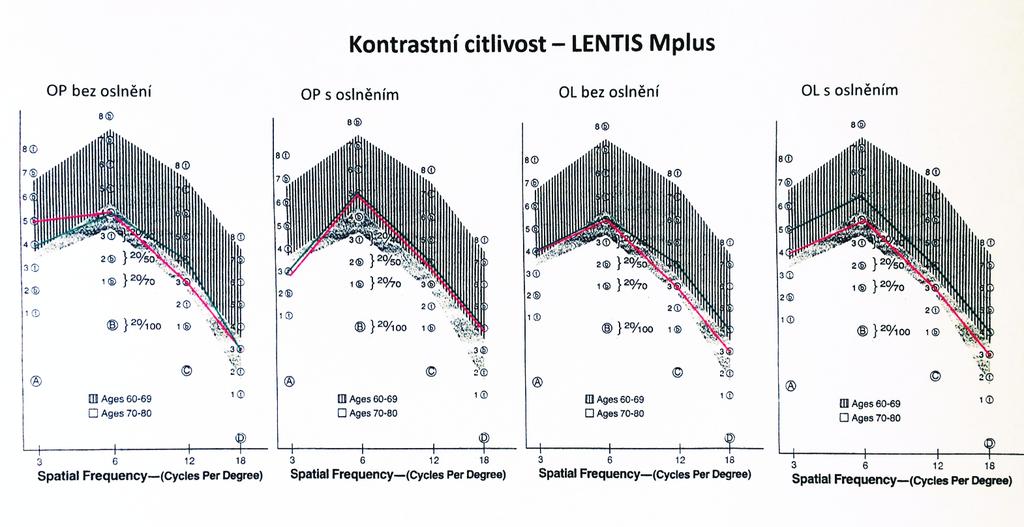 Obr. 1 Hodnoty kontrastní citlivosti ve skupině A (implantace Lentis Mplus) Vysvětlivky: zeleně: průměrné předoperační hodnoty, červeně: průměrné hodnoty na konci sledovacího období (6 měsíců po