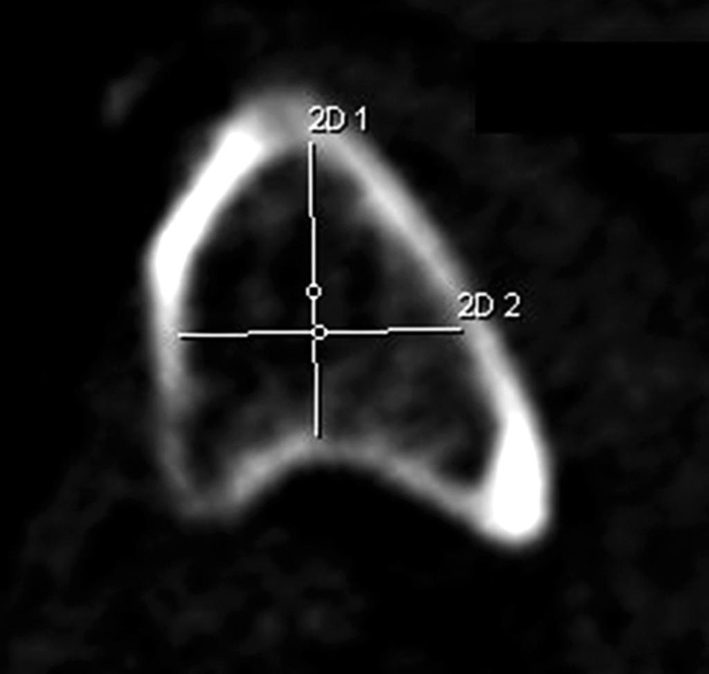 148/ Acta Chir. orthop. Traum. čech., 83, 2016, No. 3 PŮVODNÍ PRÁCE ÚVOD Při ošetření zlomenin pánve se stále více uplatňují minimálně invazivní metody (1, 2, 4, 7, 8, 10, 13).