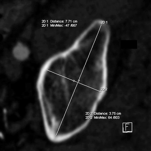 150/ Acta Chir. orthop. Traum. čech., 83, 2016, No. 3 PŮVODNÍ PRÁCE Tab. 3. Definice měřených rozměrů S1 a S2 obratlů K.