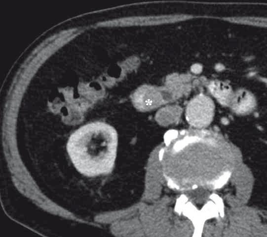 SURGICAL TREATMENT OF AMPULLARY ADENOCARCINOMA SINGLE CENTER EXPERIENCE AND A REVIEW OF LITERATURE A B Fig. 2. An invasive ampullary carcinoma. A. Contrast enhanced CT, portal venous phase.