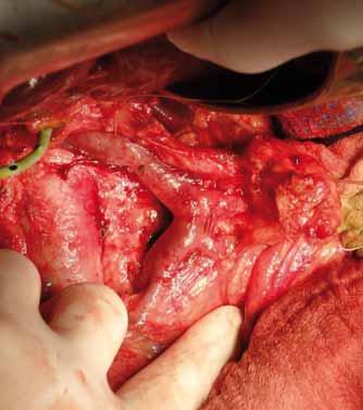 SURGICAL TREATMENT OF AMPULLARY ADENOCARCINOMA SINGLE CENTER EXPERIENCE AND A REVIEW OF LITERATURE Fig. 6.