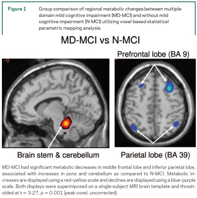 Funkční zobrazení MCI_PD FDG PET MCI má FDG PET metabolický korelát FDG PET